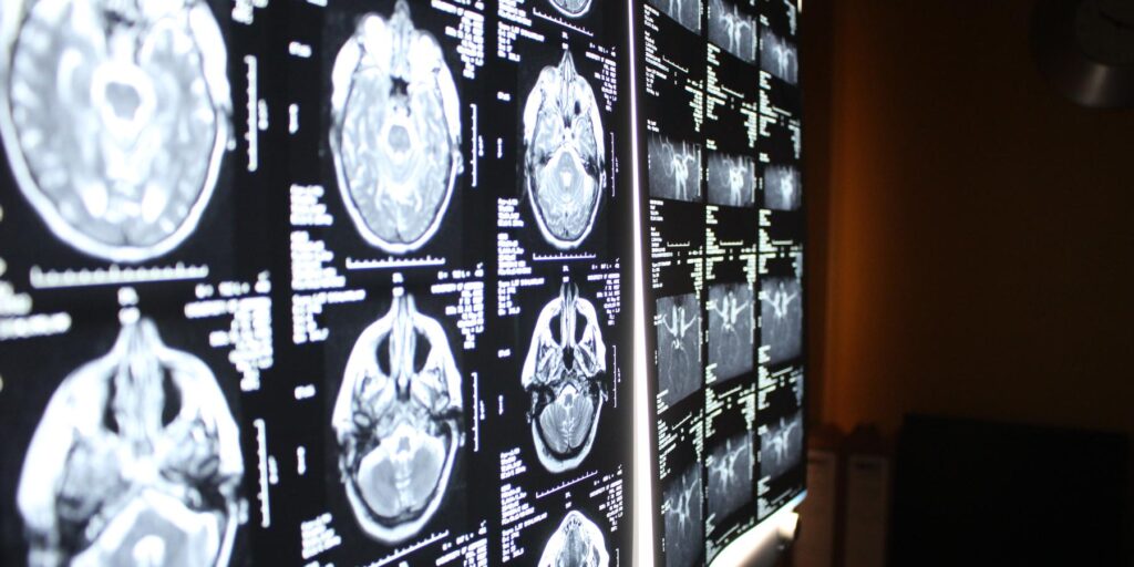 Brain scan